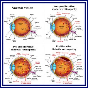 Diabetic Eye Problems – Information, Treatment, Prevention, A Guide