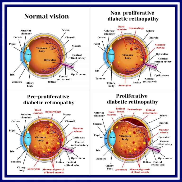 diabetic-eye-problems-information-treatment-prevention-a-guide