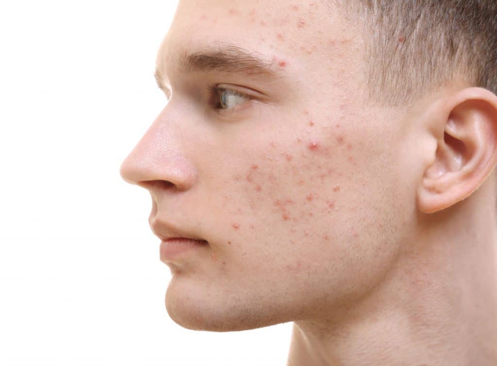Chronic Skin Conditions