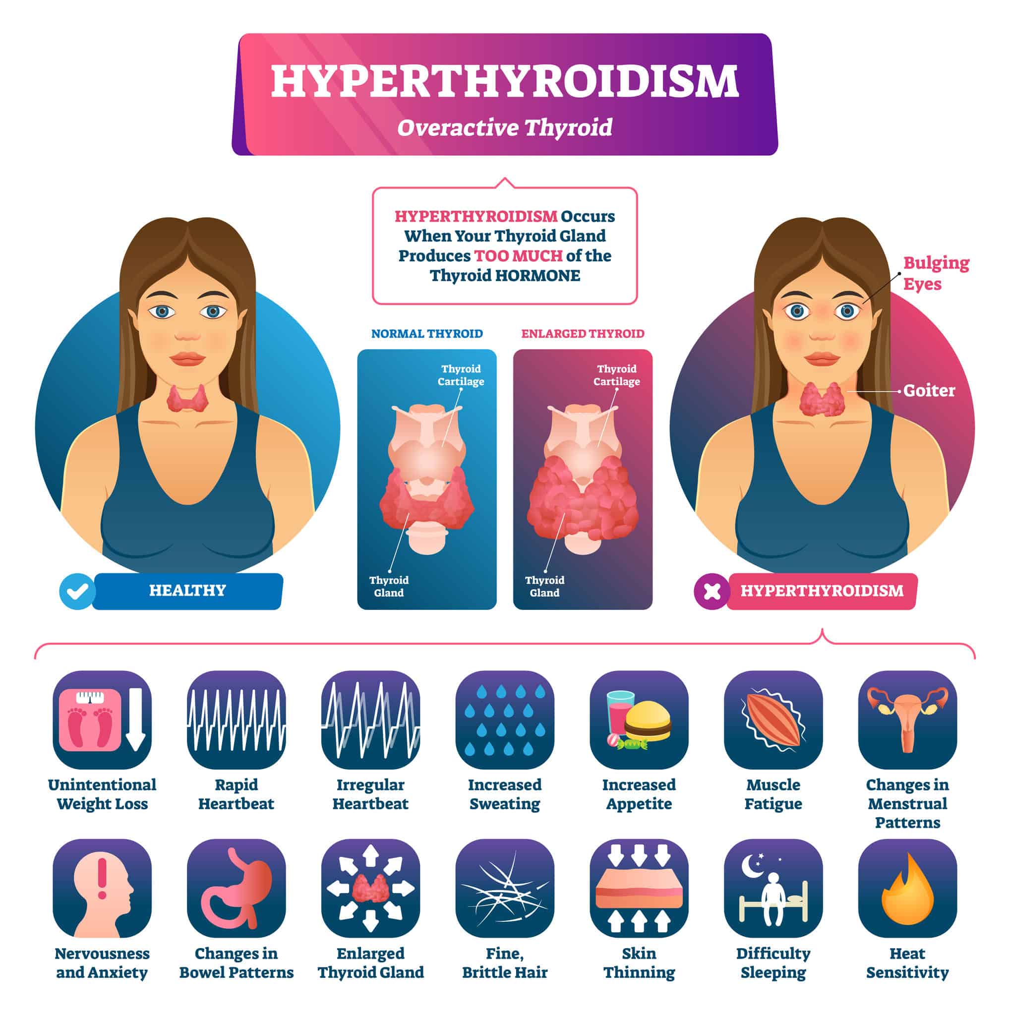 thyroid and sweating