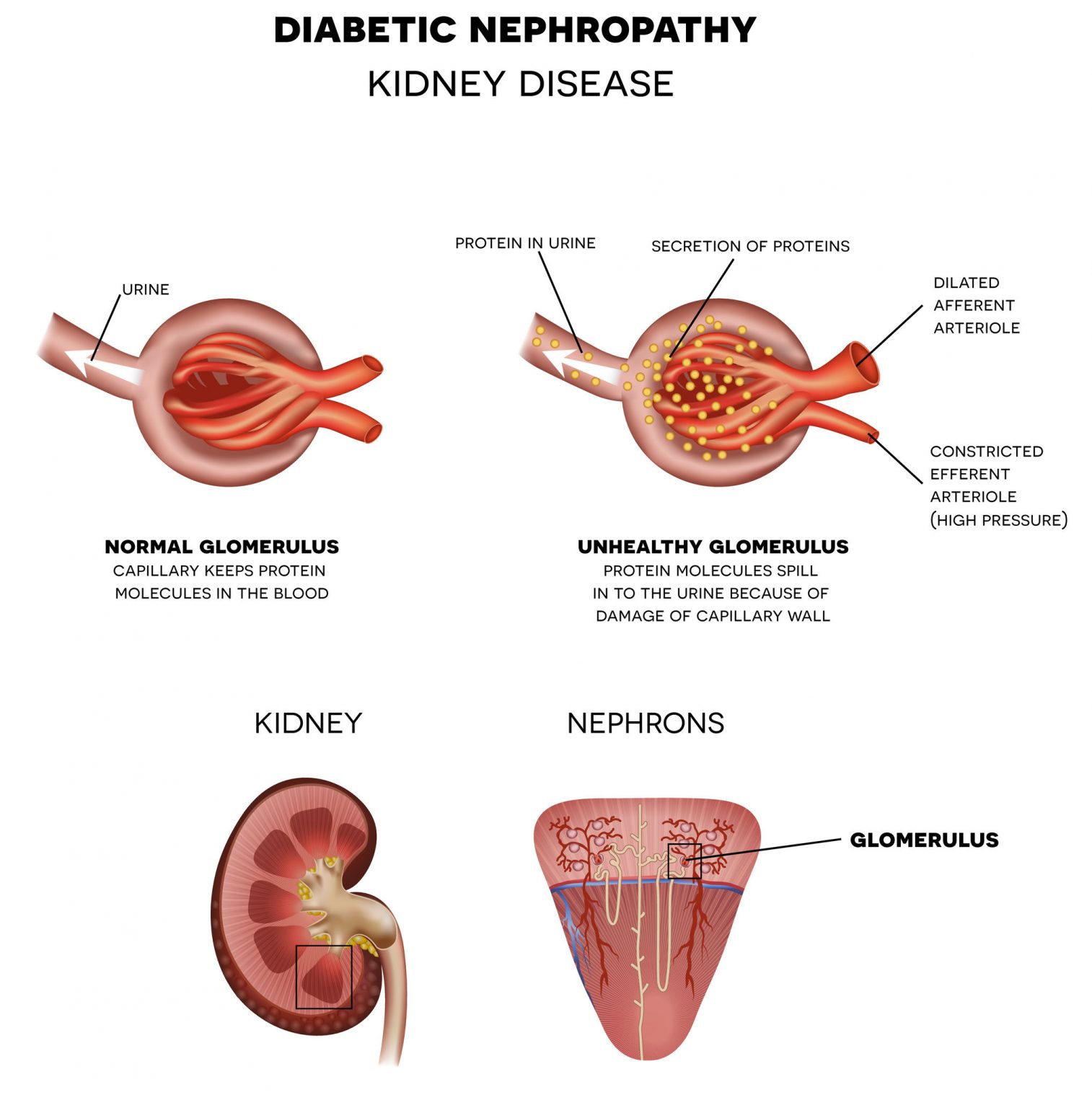 Image depicting how diabetes affects kidneys