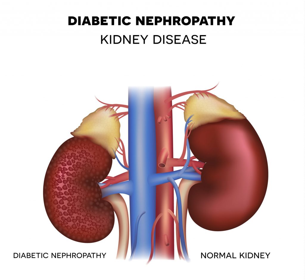 How Diabetes Affects Your Kidneys