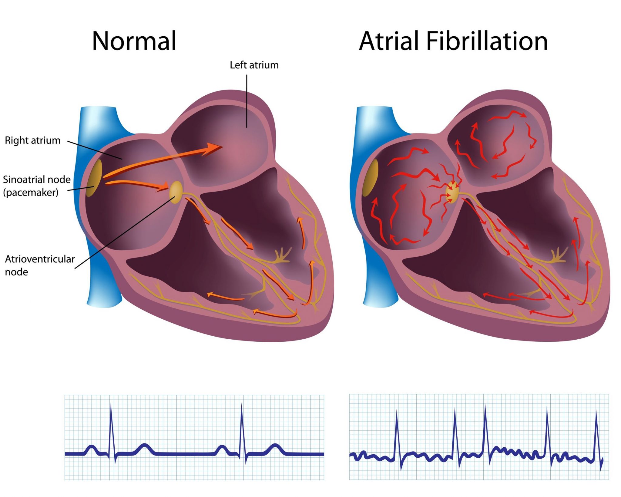 What is Atrial Fibrillation? Symptoms, Causes, Triggers