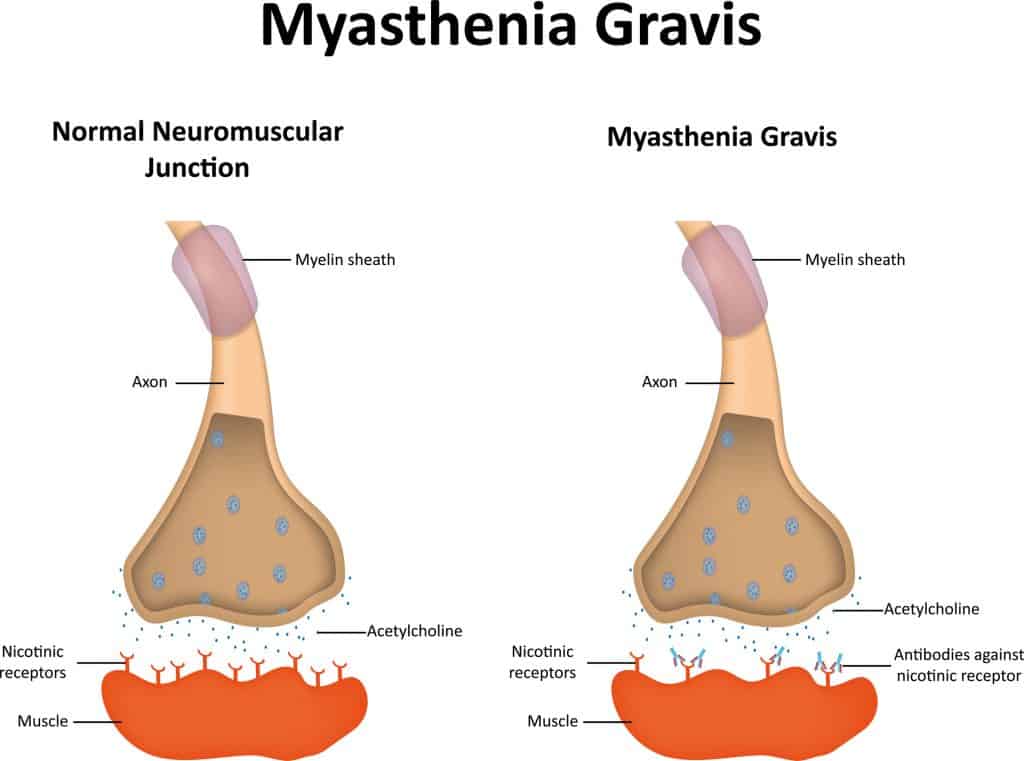 What Is Myasthenia Gravis Causes Symptoms Treatment 9520