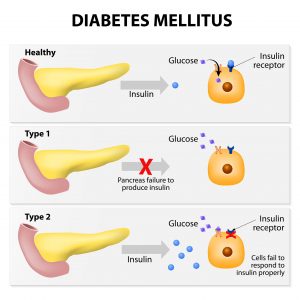 Does the Pancreas Produce Insulin? What the Pancreas Does!