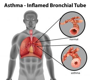 nocturnal asthma left lung mucous