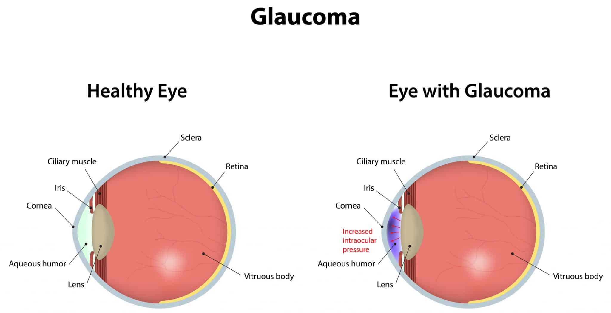 CBD and Glaucoma, Pros and Cons, Effects, and Best Advice