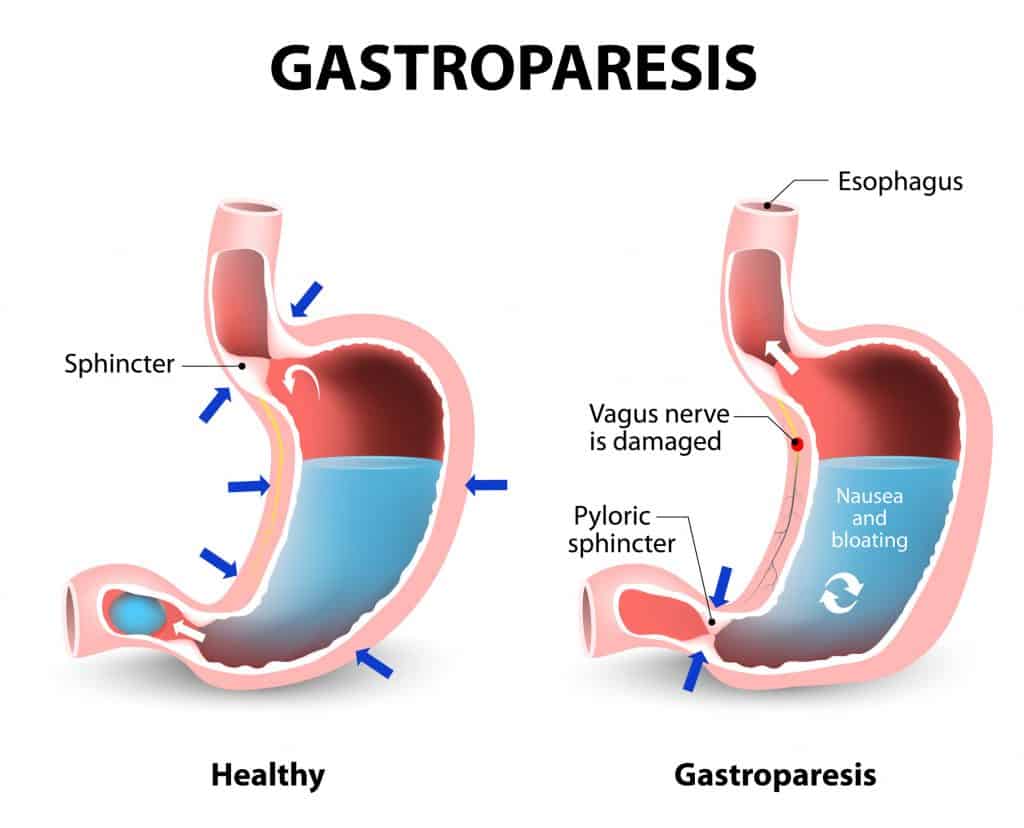 Diabetic Gastroparesis