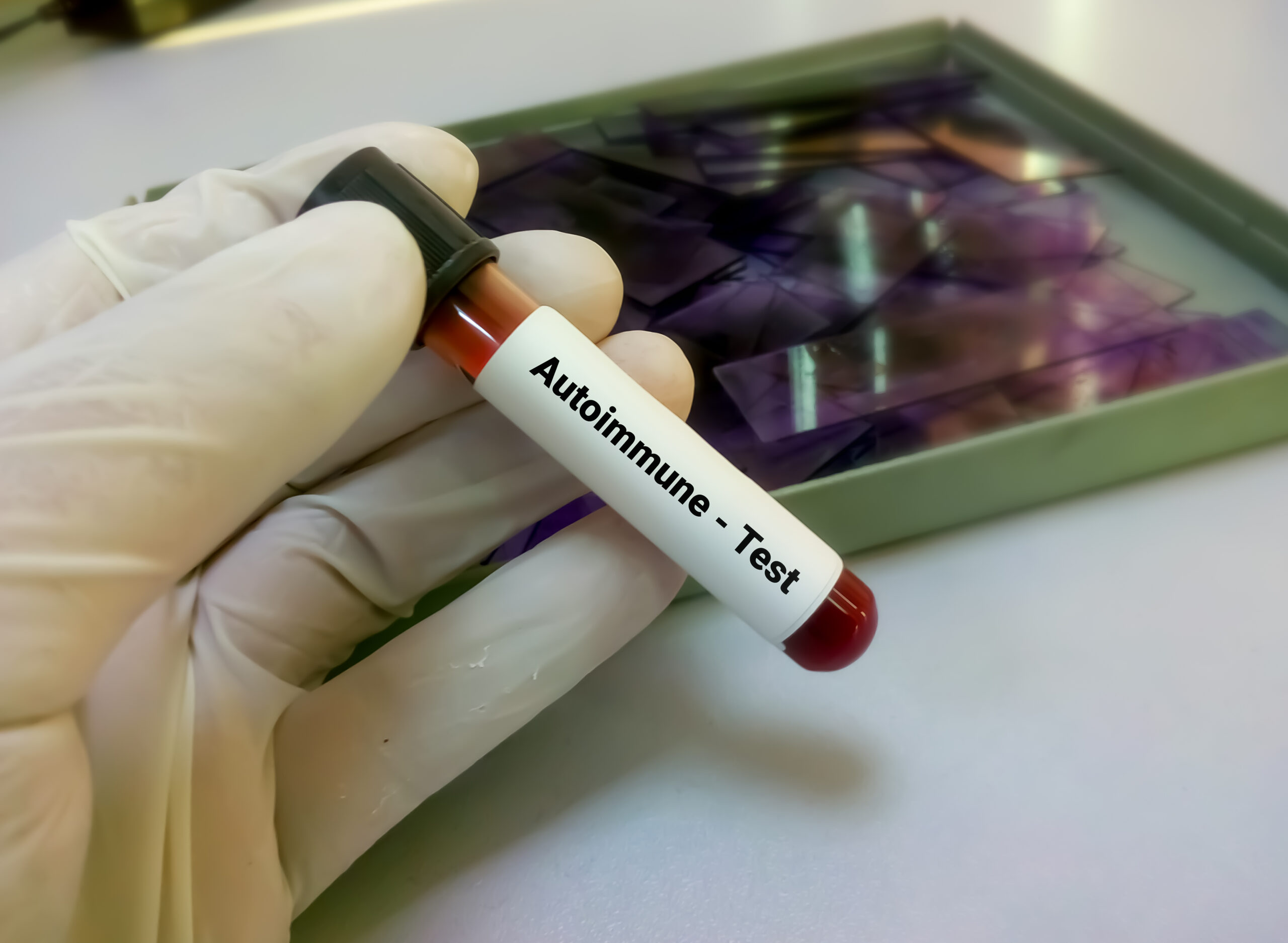 Early signs of autoimmune disease