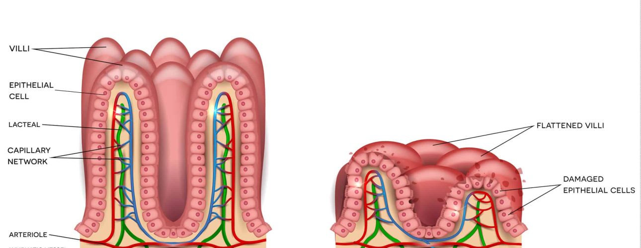 Celiac disease affected small intestine villi on a white background. Healthy villi and unhealthy villi with damaged cells