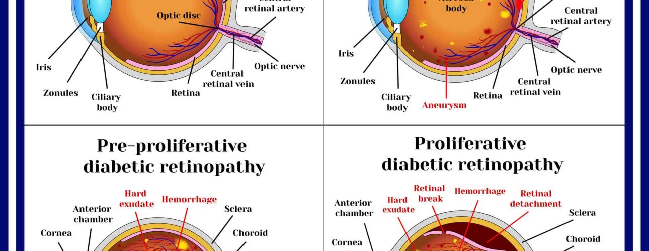 Types of diabetic retinopathy: non-proliferative, pre-proliferative diabetic retinopathy, proliferative retinopathy of retina.