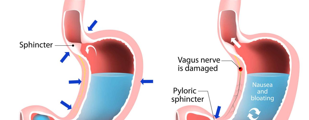 Gastroparesis or delayed gastric emptying. Visual comparison of healthy gastric and stomach with Gastroparesis.