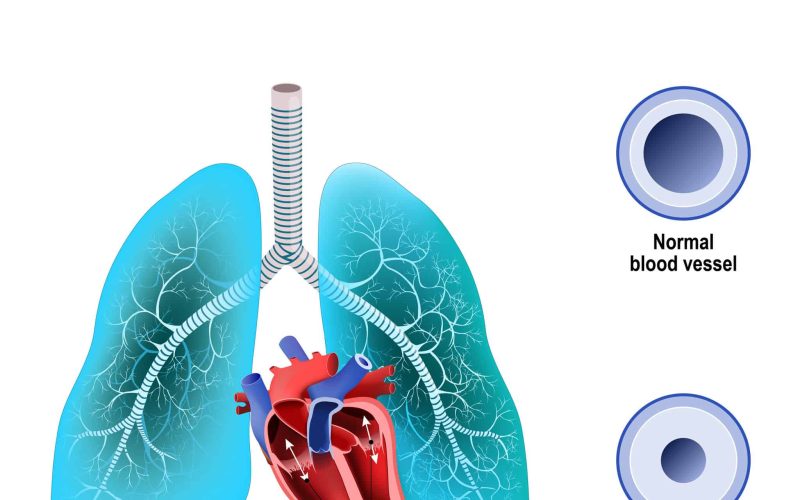 Does-Tadalafil-Lower-Blood-Pressure