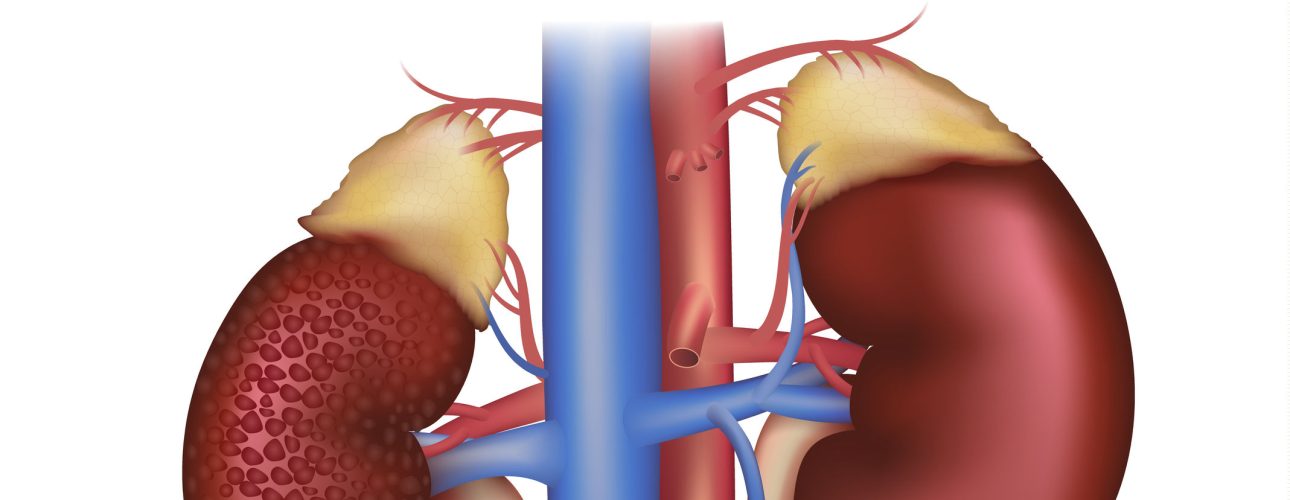 Diabetic Nephropathy, kidney disease caused by Diabetes