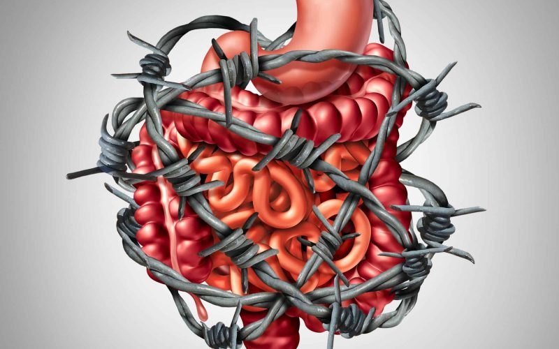 Painful digestion IBS or irritable bowel syndrome and intestine pain or Intestinal discomfort inflammation problem or constipation as barbed wire with 3D illustration elements.