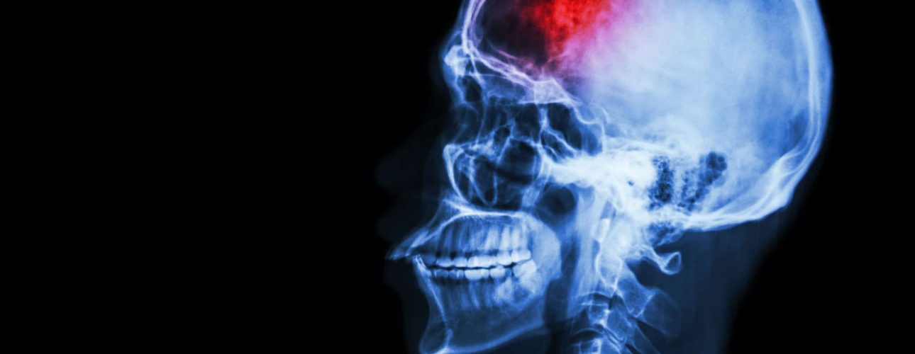 31823570 - "stroke" (cerebrovascular accident). film x-ray skull lateral with stroke and blank area at left side